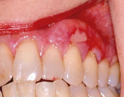 white gums